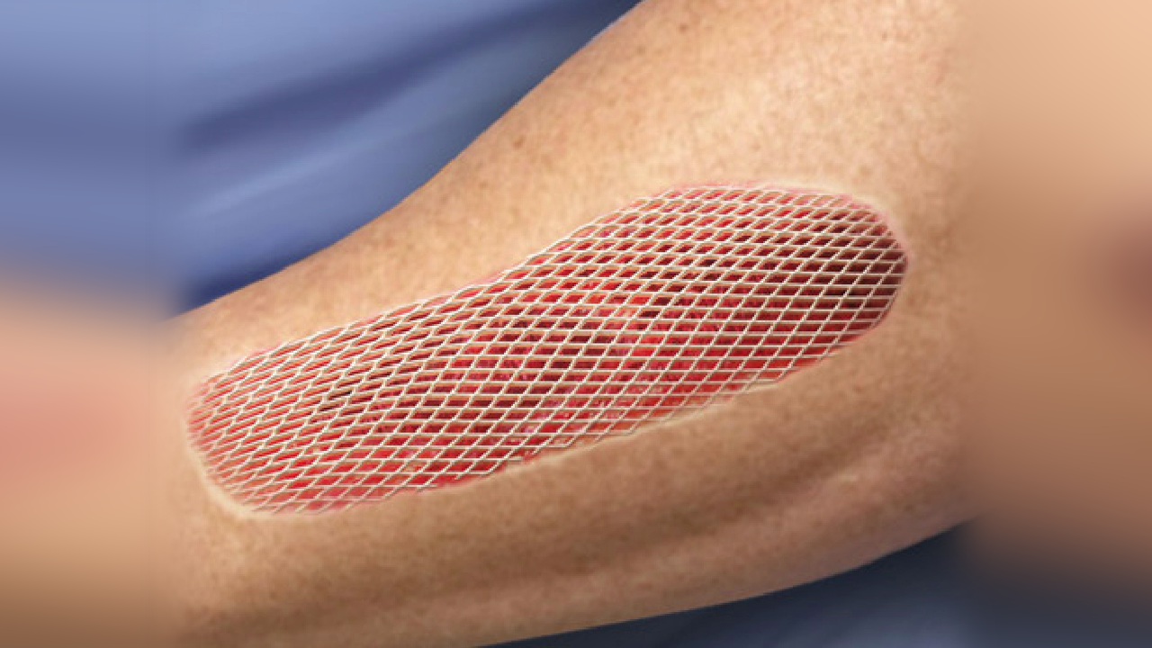 Skin Grafting – Skin and Allergy Centre Kanpur